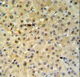 PSME1 Antibody - PSME1 Antibody IHC of formalin-fixed and paraffin-embedded hepatocarcinoma followed by peroxidase-conjugated secondary antibody and DAB staining.
