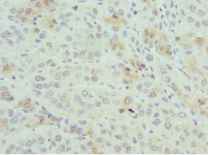 PSME1 Antibody - Immunohistochemistry of paraffin-embedded human liver cancer at dilution 1:100