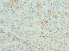PSME1 Antibody - Immunohistochemistry of paraffin-embedded human liver cancer at dilution 1:100