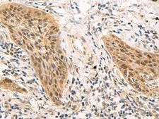 PSME1 Antibody - Immunohistochemistry of paraffin-embedded Human esophagus cancer tissue  using PSME1 Polyclonal Antibody at dilution of 1:50(×200)