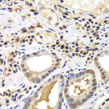 PSME2 Antibody - Immunohistochemistry of paraffin-embedded human gastric cancer tissue.
