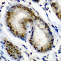 PSME2 Antibody - Immunohistochemical analysis of PA28 beta staining in human gastric cancer formalin fixed paraffin embedded tissue section. The section was pre-treated using heat mediated antigen retrieval with sodium citrate buffer (pH 6.0). The section was then incubated with the antibody at room temperature and detected using an HRP conjugated compact polymer system. DAB was used as the chromogen. The section was then counterstained with hematoxylin and mounted with DPX.
