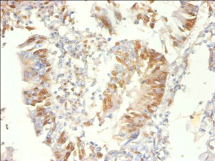 PSME3 Antibody - Immunohistochemistry of paraffin-embedded human colon cancer using PSME3 Antibody at dilution of 1:100