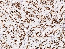 PSME3 Antibody - Immunochemical staining of human PSME3 in human breast carcinoma with rabbit polyclonal antibody at 1:10000 dilution, formalin-fixed paraffin embedded sections.