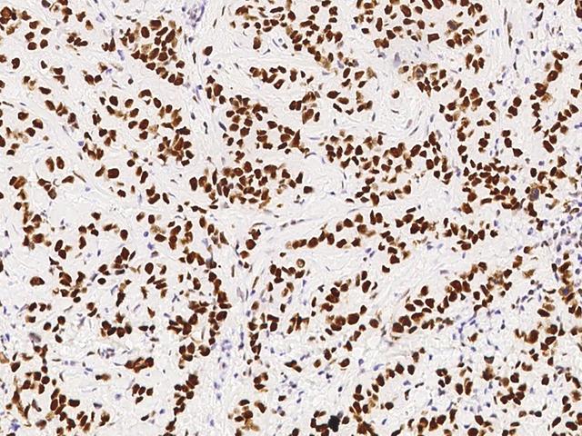 PSME3 Antibody - Immunochemical staining of human PSME3 in human breast carcinoma with rabbit polyclonal antibody at 1:10000 dilution, formalin-fixed paraffin embedded sections.