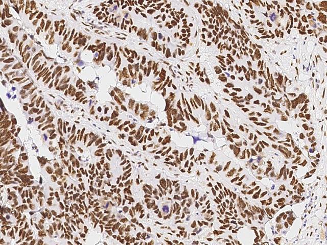PSME3 Antibody - Immunochemical staining of human PSME3 in human colon carcinoma with rabbit polyclonal antibody at 1:10000 dilution, formalin-fixed paraffin embedded sections.