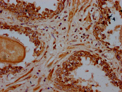 PSME4 / PA200 Antibody - Immunohistochemistry Dilution at 1:600 and staining in paraffin-embedded human prostate cancer performed on a Leica BondTM system. After dewaxing and hydration, antigen retrieval was mediated by high pressure in a citrate buffer (pH 6.0). Section was blocked with 10% normal Goat serum 30min at RT. Then primary antibody (1% BSA) was incubated at 4°C overnight. The primary is detected by a biotinylated Secondary antibody and visualized using an HRP conjugated SP system.
