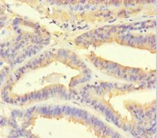 PSMF1 Antibody - Immunohistochemistry of paraffin-embedded human endometrial cancer using Rabbit anti-human Proteasome inhibitor PI31 subunit polyclonal Antibody at dilution of 1:100