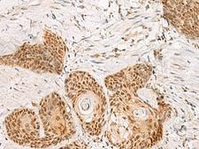 PSPC1 Antibody - Immunohistochemistry of paraffin-embedded Human esophagus cancer tissue  using PSPC1 Polyclonal Antibody at dilution of 1:30(×200)
