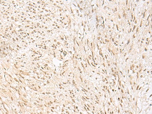 PSPC1 Antibody - Immunohistochemistry of paraffin-embedded Human liver cancer tissue  using PSPC1 Polyclonal Antibody at dilution of 1:30(×200)