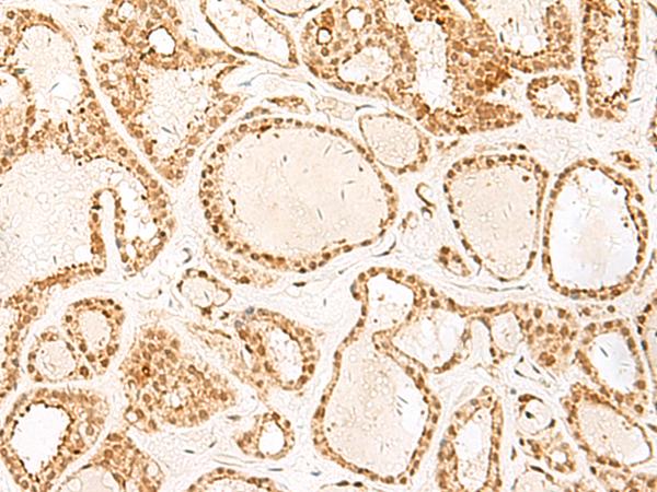 PSPC1 Antibody - Immunohistochemistry of paraffin-embedded Human thyroid cancer tissue  using PSPC1 Polyclonal Antibody at dilution of 1:25(×200)