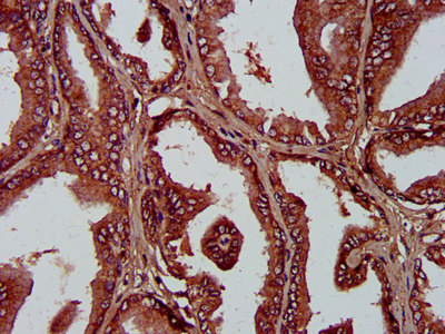 PSPLA1 / Phospholipase A1 Antibody - Immunohistochemistry image at a dilution of 1:400 and staining in paraffin-embedded human prostate tissue performed on a Leica BondTM system. After dewaxing and hydration, antigen retrieval was mediated by high pressure in a citrate buffer (pH 6.0) . Section was blocked with 10% normal goat serum 30min at RT. Then primary antibody (1% BSA) was incubated at 4 °C overnight. The primary is detected by a biotinylated secondary antibody and visualized using an HRP conjugated SP system.