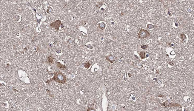 PSRC1 / DDA3 Antibody - 1:100 staining human brain carcinoma tissue by IHC-P. The sample was formaldehyde fixed and a heat mediated antigen retrieval step in citrate buffer was performed. The sample was then blocked and incubated with the antibody for 1.5 hours at 22°C. An HRP conjugated goat anti-rabbit antibody was used as the secondary.