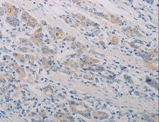 PTAFR / PAF Receptor Antibody - Immunohistochemistry of paraffin-embedded Human gastric cancer using PTAFR Polyclonal Antibody at dilution of 1:70.