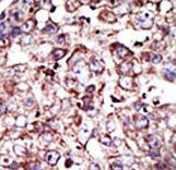 PTAR2 / FNTA Antibody - Formalin-fixed and paraffin-embedded human cancer tissue reacted with the primary antibody, which was peroxidase-conjugated to the secondary antibody, followed by DAB staining. This data demonstrates the use of this antibody for immunohistochemistry; clinical relevance has not been evaluated. BC = breast carcinoma; HC = hepatocarcinoma.