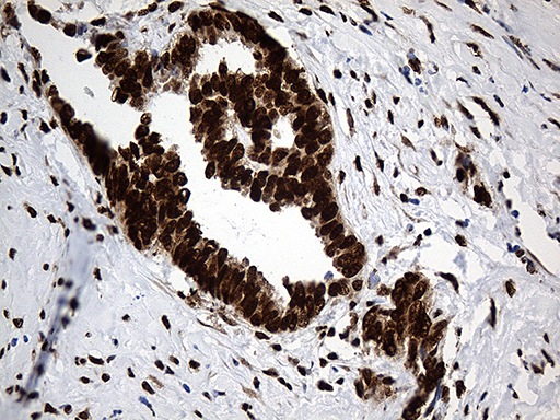 PTBP3 / ROD1 Antibody - Immunohistochemical staining of paraffin-embedded Adenocarcinoma of Human ovary tissue using anti-PTBP3 mouse monoclonal antibody. (Heat-induced epitope retrieval by 1mM EDTA in 10mM Tris buffer. (pH8.5) at 120°C for 3 min. (1:500)