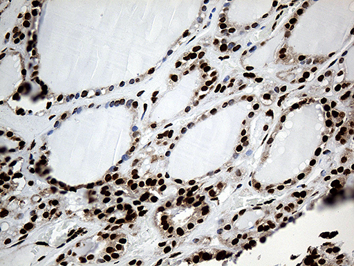 PTBP3 / ROD1 Antibody - Immunohistochemical staining of paraffin-embedded Human thyroid tissue within the normal limits using anti-PTBP3 mouse monoclonal antibody. (Heat-induced epitope retrieval by 1mM EDTA in 10mM Tris buffer. (pH8.5) at 120°C for 3 min. (1:500)