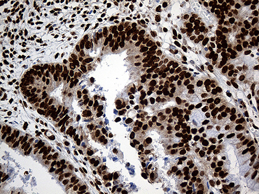 PTBP3 / ROD1 Antibody - Immunohistochemical staining of paraffin-embedded Adenocarcinoma of Human endometrium tissue using anti-PTBP3 mouse monoclonal antibody. (Heat-induced epitope retrieval by 1mM EDTA in 10mM Tris buffer. (pH8.5) at 120°C for 3 min. (1:500)