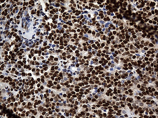 PTBP3 / ROD1 Antibody - Immunohistochemical staining of paraffin-embedded Adenocarcinoma of Human breast tissue tissue using anti-PTBP3 mouse monoclonal antibody. (Heat-induced epitope retrieval by 1mM EDTA in 10mM Tris buffer. (pH8.5) at 120°C for 3 min. (1:500)