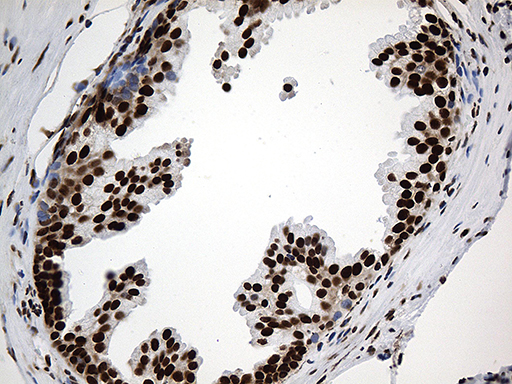 PTBP3 / ROD1 Antibody - Immunohistochemical staining of paraffin-embedded Carcinoma of Human prostate tissue using anti-PTBP3 mouse monoclonal antibody. (Heat-induced epitope retrieval by 1mM EDTA in 10mM Tris buffer. (pH8.5) at 120°C for 3 min. (1:500)