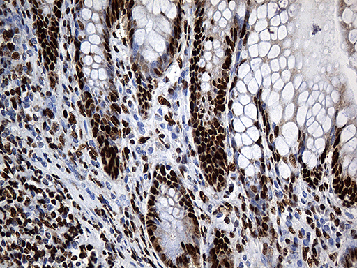 PTBP3 / ROD1 Antibody - Immunohistochemical staining of paraffin-embedded Human colon tissue within the normal limits using anti-PTBP3 mouse monoclonal antibody. (Heat-induced epitope retrieval by 1mM EDTA in 10mM Tris buffer. (pH8.5) at 120°C for 3 min. (1:500)