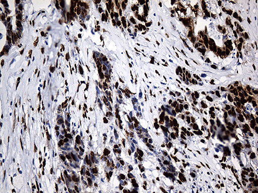 PTBP3 / ROD1 Antibody - Immunohistochemical staining of paraffin-embedded Adenocarcinoma of Human colon tissue using anti-PTBP3 mouse monoclonal antibody. (Heat-induced epitope retrieval by 1mM EDTA in 10mM Tris buffer. (pH8.5) at 120°C for 3 min. (1:500)