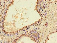 PTCD2 Antibody - Immunohistochemistry of paraffin-embedded human prostate cancer using PTCD2 Antibody at dilution of 1:100