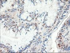 PTCH1 / Patched 1 Antibody - IHC of paraffin-embedded Adenocarcinoma of colon using anti-PTCH1 mouse monoclonal antibody.