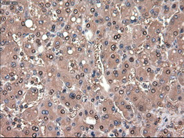PTCH1 / Patched 1 Antibody - IHC of paraffin-embedded Carcinoma of liver using anti-PTCH1 mouse monoclonal antibody.