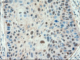 PTCH1 / Patched 1 Antibody - IHC of paraffin-embedded Carcinoma of lung using anti-PTCH1 mouse monoclonal antibody.