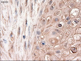 PTCH1 / Patched 1 Antibody - IHC of paraffin-embedded Carcinoma of pancreas using anti-PTCH1 mouse monoclonal antibody.