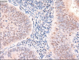 PTCH1 / Patched 1 Antibody - IHC of paraffin-embedded Adenocarcinoma of endometrium using anti-PTCH1 mouse monoclonal antibody.