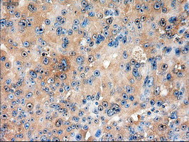 PTCH1 / Patched 1 Antibody - IHC of paraffin-embedded Adenocarcinoma of ovary using anti-PTCH1 mouse monoclonal antibody.