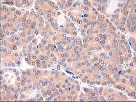 PTCH1 / Patched 1 Antibody - IHC of paraffin-embedded Carcinoma of thyroid using anti-PTCH1 mouse monoclonal antibody.