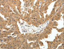 PTCH1 / Patched 1 Antibody - Immunohistochemistry of paraffin-embedded Human ovarian cancer using PTCH1 Polyclonal Antibody at dilution of 1:50.