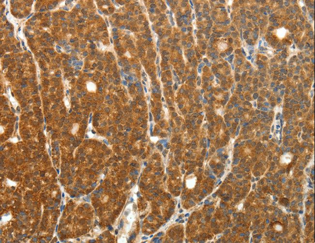 PTCH1 / Patched 1 Antibody - Immunohistochemistry of paraffin-embedded Human thyroid cancer using PTCH1 Polyclonal Antibody at dilution of 1:50.
