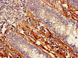 PTCH1 / Patched 1 Antibody - Immunohistochemistry of paraffin-embedded human colon cancer using PTCH1 Antibody at dilution of 1:100