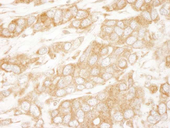 PTEN Antibody - Detection of Human PTEN by Immunohistochemistry. Sample: FFPE section of human breast carcinoma. Antibody: Affinity purified rabbit anti-PTEN used at a dilution of 1:250.