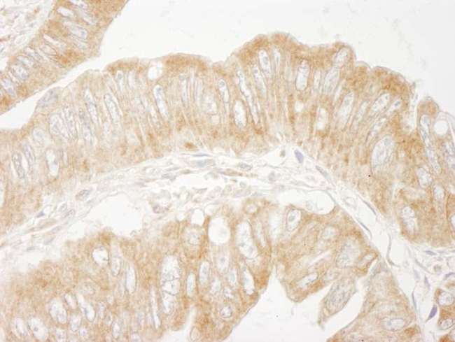 PTEN Antibody - Detection of Human PTEN by Immunohistochemistry. Sample: FFPE section of human colon carcinoma. Antibody: Affinity purified rabbit anti-PTEN used at a dilution of 1:250.