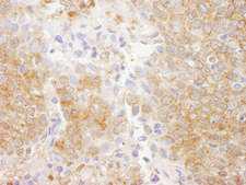 PTEN Antibody - Detection of Human PTEN by Immunohistochemistry. Sample: FFPE section of human breast carcinoma. Antibody: Affinity purified rabbit anti-PTEN used at a dilution of 1:200 (1 ug/ml). Detection: DAB.