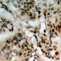 PTEN Antibody - Immunohistochemical analysis of PTEN (pS380/T382/T383) staining in human prostate cancer formalin fixed paraffin embedded tissue section. The section was pre-treated using heat mediated antigen retrieval with sodium citrate buffer (pH 6.0). The section was then incubated with the antibody at room temperature and detected with HRP and DAB as chromogen. The section was then counterstained with hematoxylin and mounted with DPX.