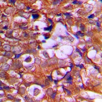 PTEN Antibody - Immunohistochemical analysis of PTEN staining in human prostate cancer formalin fixed paraffin embedded tissue section. The section was pre-treated using heat mediated antigen retrieval with sodium citrate buffer (pH 6.0). The section was then incubated with the antibody at room temperature and detected with HRP and DAB as chromogen. The section was then counterstained with hematoxylin and mounted with DPX.
