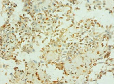 PTEN Antibody - Immunohistochemistry of paraffin-embedded human breast cancer using PTEN Antibody at dilution of 1: 100