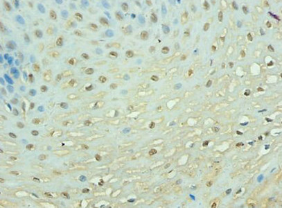PTEN Antibody - Immunohistochemistry of paraffin-embedded human esophageal cancer using PTEN Antibody at dilution of 1: 100