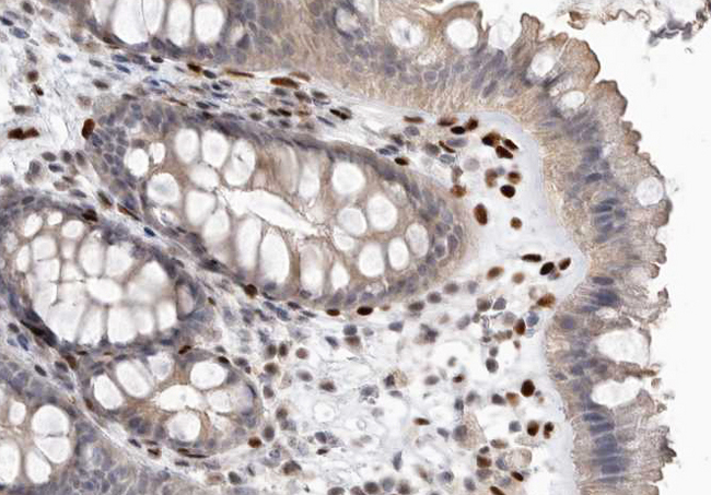 PTEN Antibody - 1:200 staining human colon carcinoma tissue by IHC-P. The tissue was formaldehyde fixed and a heat mediated antigen retrieval step in citrate buffer was performed. The tissue was then blocked and incubated with the antibody for 1.5 hours at 22°C. An HRP conjugated goat anti-rabbit antibody was used as the secondary.