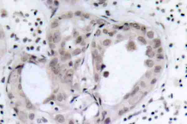 PTEN Antibody - Immunohistochemistry (IHC) analysis of p-c-Myc (S62) pAb in paraffin-embedded human breast cancer tissue.