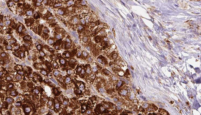 PTGER1 / EP1 Antibody - 1:100 staining human liver carcinoma tissues by IHC-P. The sample was formaldehyde fixed and a heat mediated antigen retrieval step in citrate buffer was performed. The sample was then blocked and incubated with the antibody for 1.5 hours at 22°C. An HRP conjugated goat anti-rabbit antibody was used as the secondary.
