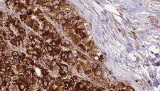 PTGER1 / EP1 Antibody - 1:100 staining human liver carcinoma tissues by IHC-P. The sample was formaldehyde fixed and a heat mediated antigen retrieval step in citrate buffer was performed. The sample was then blocked and incubated with the antibody for 1.5 hours at 22°C. An HRP conjugated goat anti-rabbit antibody was used as the secondary.