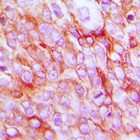 PTGER2 / EP2 Antibody - Immunohistochemical analysis of EP2 staining in human prostate cancer formalin fixed paraffin embedded tissue section. The section was pre-treated using heat mediated antigen retrieval with sodium citrate buffer (pH 6.0). The section was then incubated with the antibody at room temperature and detected using an HRP polymer system. DAB was used as the chromogen. The section was then counterstained with hematoxylin and mounted with DPX.