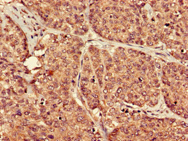 PTGER3 / EP3 Antibody - Immunohistochemistry of paraffin-embedded human ovarian cancer at dilution of 1:100